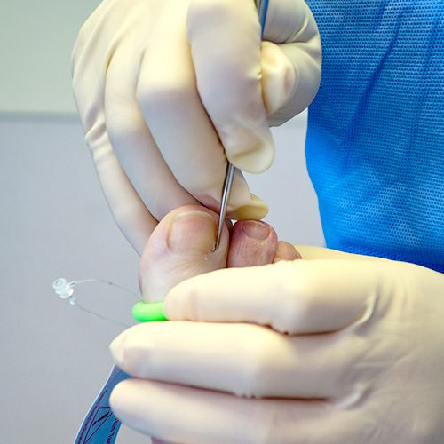 podiatrist performing ingrown toenail surgery