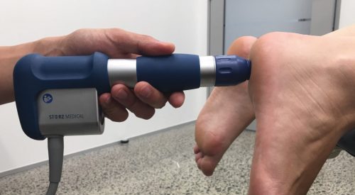 Shockwave machine being used to help heel pain