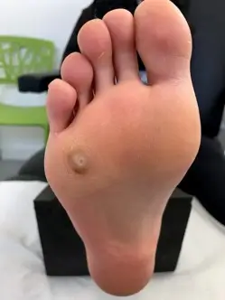 Foot showing a verruca wart on the bottom of the foot